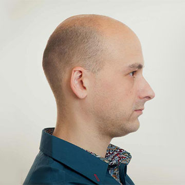 Showing Signs of Balding? Here's How to Reverse Hair Loss!