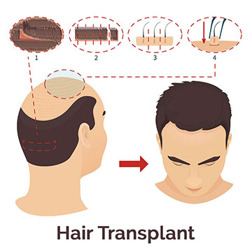 After Effects of Hair Transplant You Need to Know About