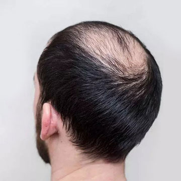 Why Caring Early Can Help Protect Your Hair from Falling later