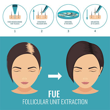 FUE Hair Transplant - Things You Need to Know