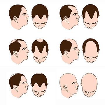 UNCOVER 4 THEORIES BEHIND  PATTERN HAIR LOSS