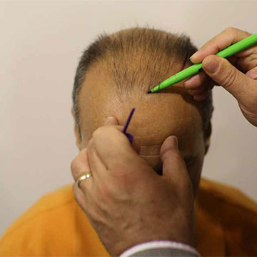 What Is the Most Suitable Time in a Year to Go for a Hair Transplant?