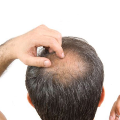 Can a Vegan Diet Lead to Hair Loss?