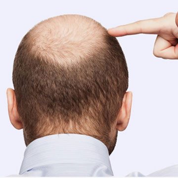 Recent Advancement in the FUE Technique