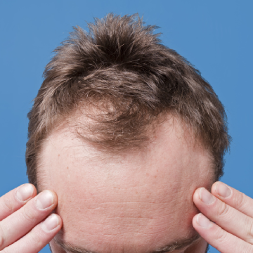 If You Have Patterned Thinning of Hair? Here Is What You Can Do About It