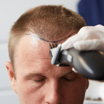 Want to Find out If You Are Eligible for a Hair Transplant? Well, Advanced Hair Studio Might Be the Answer You Are Looking For