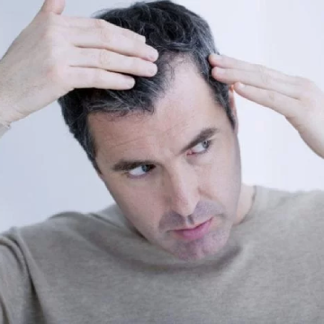 Do You Think Your Hairline Is Receding? Here Is What You Can Do About It