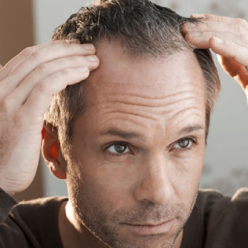 How Effective Can Homoeopathic Treatments be for Treating Hair Loss?