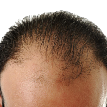 Uncovering the Truth About Invisible Baldness