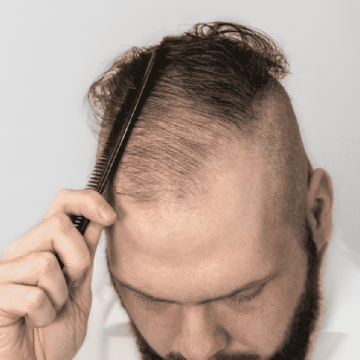 Top 3 Myths About  Topical Finasteride