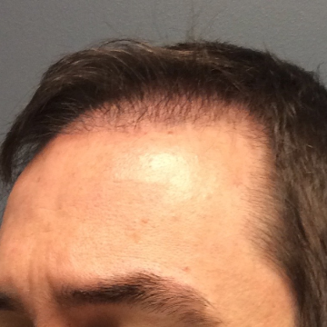 Why Does Donor Hair Continue to Grow After Hair Transplant Surgery?