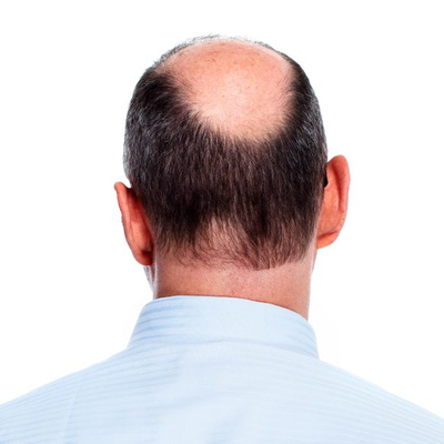 Male Hair Loss- Can a Person Regrow Hair If he is Over 50 or is it Too Late to Address Male Pattern Baldness at the Age of 50?