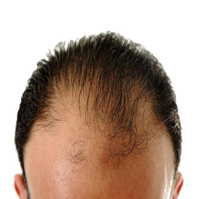 Fatty and High Cholesterol Diet Can Contribute to Hair Loss!