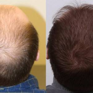From Bald to a Head Full of Hair- Advanced Hair Studio