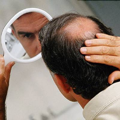 Can Obesity Cause Hair Loss?
