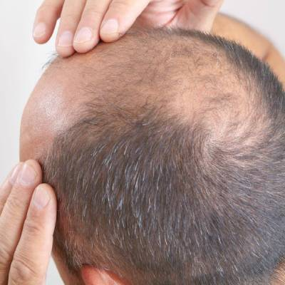 Why Excessive Consumption of Meat Could Increase the Chances of Hair Loss?