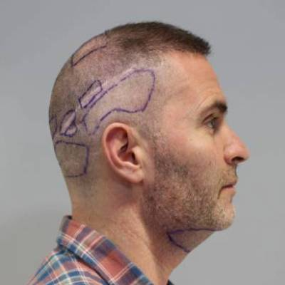 How to Identify If a Person is a Qualified Candidate for Hair Transplant?