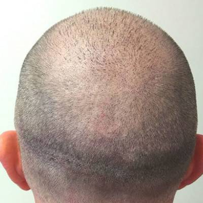 How to Avoid FUE Scar & Be Able to Manage Them