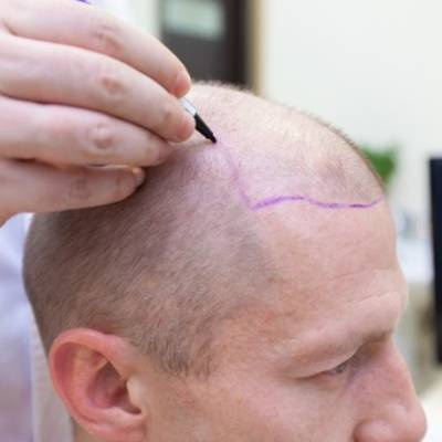 6 Lies about Hair Transplant