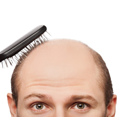 Is It True That Shorter Men Go Bald More Often?
