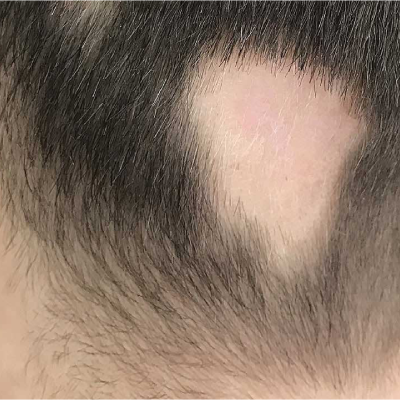 Is Alopecia Areata caused due to psychological factors?