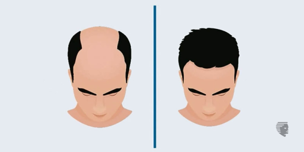 Benefits of Hair Transplant | Advanced Hair Studio