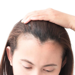 Female Pattern Baldness - Symptoms, Causes, Treatment and Prevention