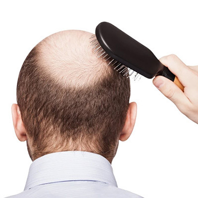How to Stop Baldness - What is the Cure?