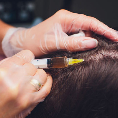 How PRP Treatment is Effective for Hair Loss?
