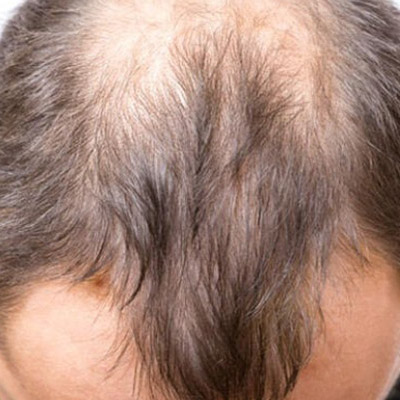 Hair Falling Out? This Could Be the Reason
