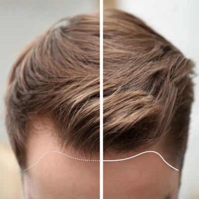 Hair Loss - Is It the Right Time for a Hair Transplant?