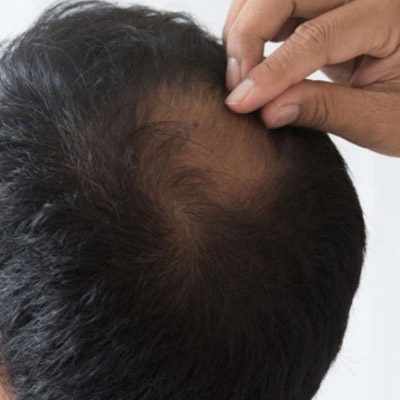 Why Not to Choose Cheap Hair Restoration Treatments