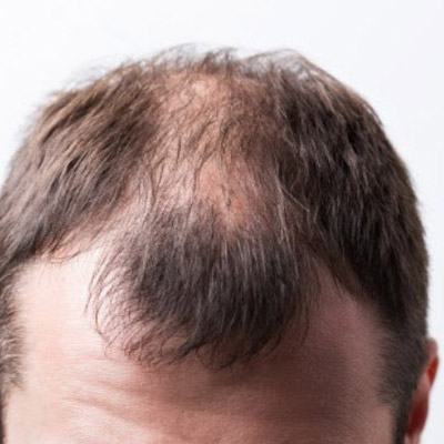 How Can You Take Care of Male Pattern Baldness