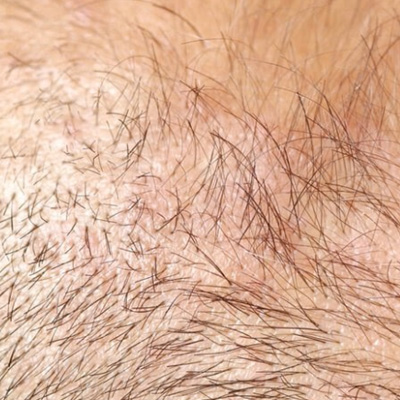 How to know If Hair Follicles are Dead or Alive?