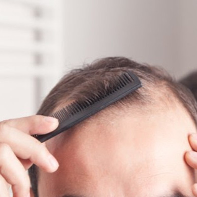 21 Best ways to Cure Male Pattern Baldness Naturally