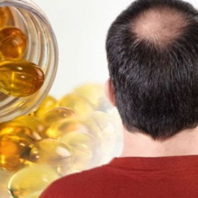 Vitamins for Hair loss: Do they help in Hair Regrowth
