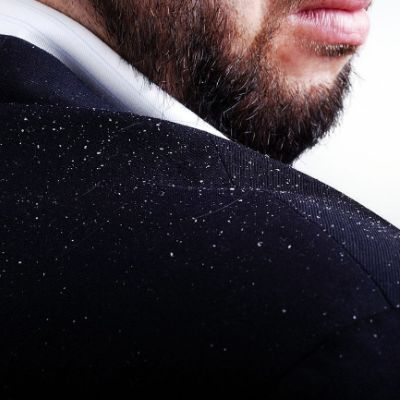 Does Dandruff Cause Hair Loss?