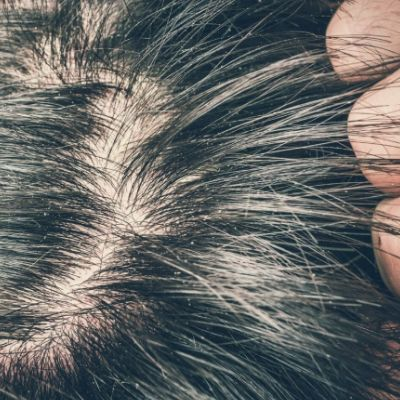 Itchy Scalp and Hair loss: How to Treat Naturally