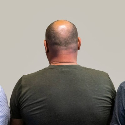 Male Pattern Baldness: How to fight with it?