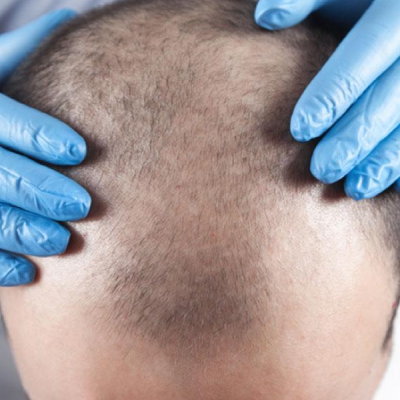 10 Ways For You To Ensure Hair Loss Treatment Success