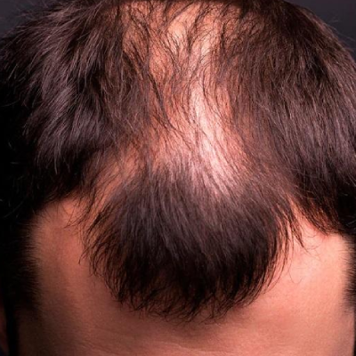 Hair Patch in Mumbai: Know the Treatment, Cost, and Benefits
