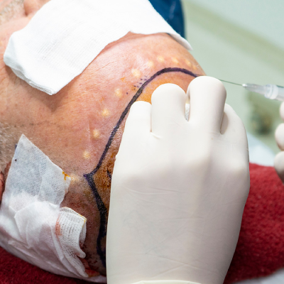 Best Hair Transplant in Gurgaon: Points to Consider Before Choosing any Clinic