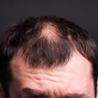 What Is Alopecia Areata and Know the Best Treatment in Ahmedabad