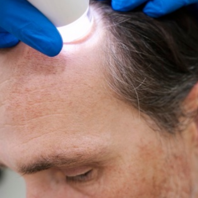 The Most Successful Hair Loss Treatment in Mumbai