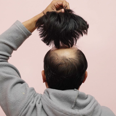 Hair Patch in Pune: A perfect solution of Baldness