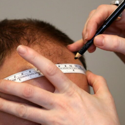8 Common Myths and Facts About Hair Transplant that you should know