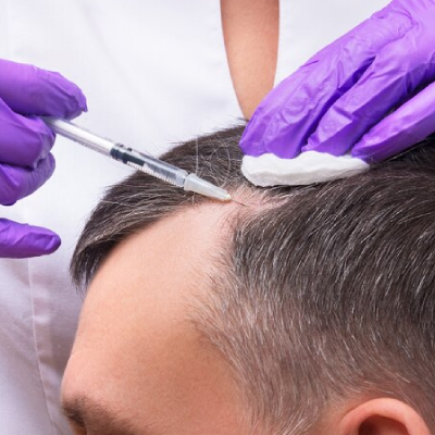 5 Things You Should Consider Before and After Hair Transplant Treatment
