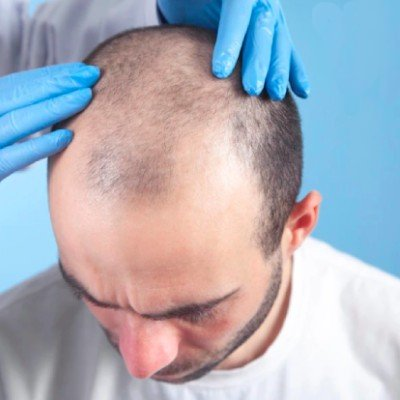 Signs of Early Hair Loss and How to Stop It