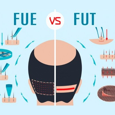 FUE vs. FUT Hair Transplant: Which Transplant Surgery is the Best?