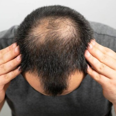 Hair Shedding vs Hair Loss: Know the Difference